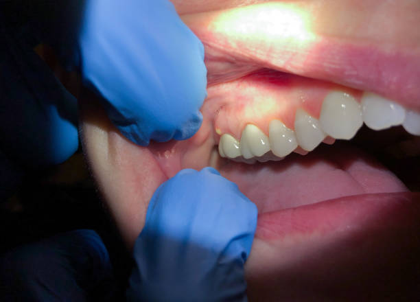 Best Emergency Dentist for Lost Fillings or Crowns in Falling Water, TN